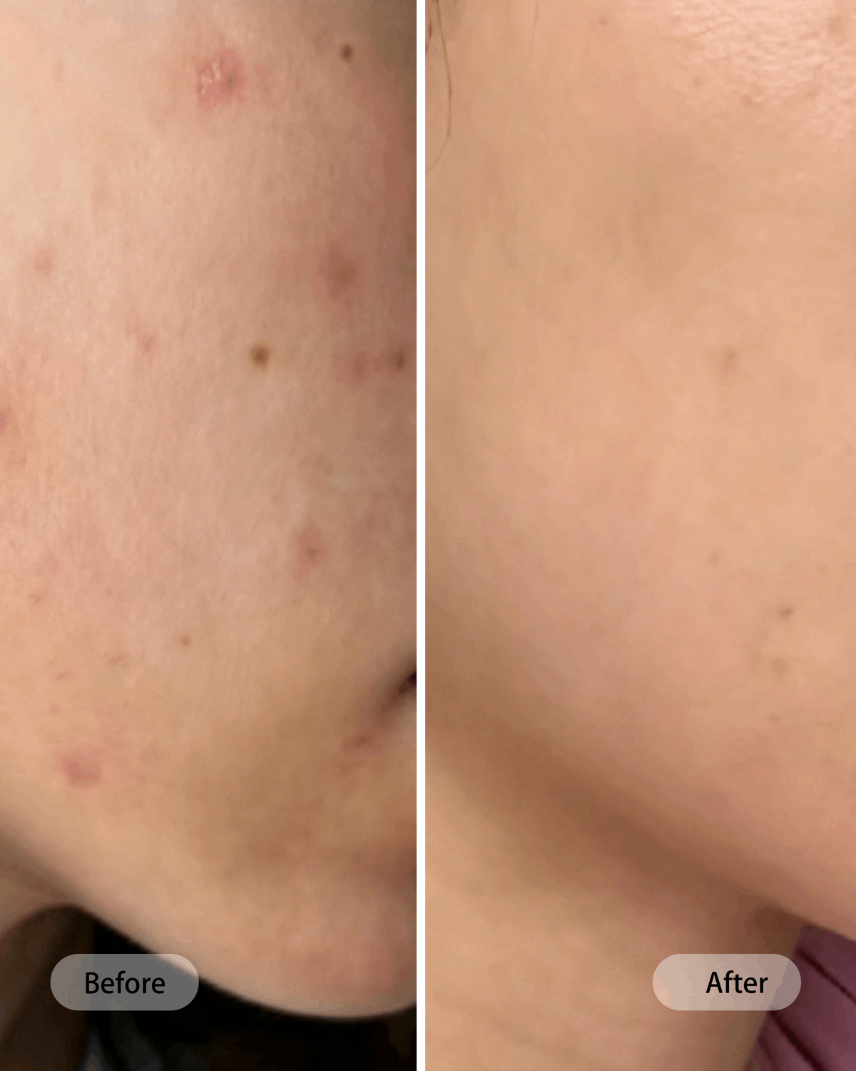 Umitec Before & After Influencer 13