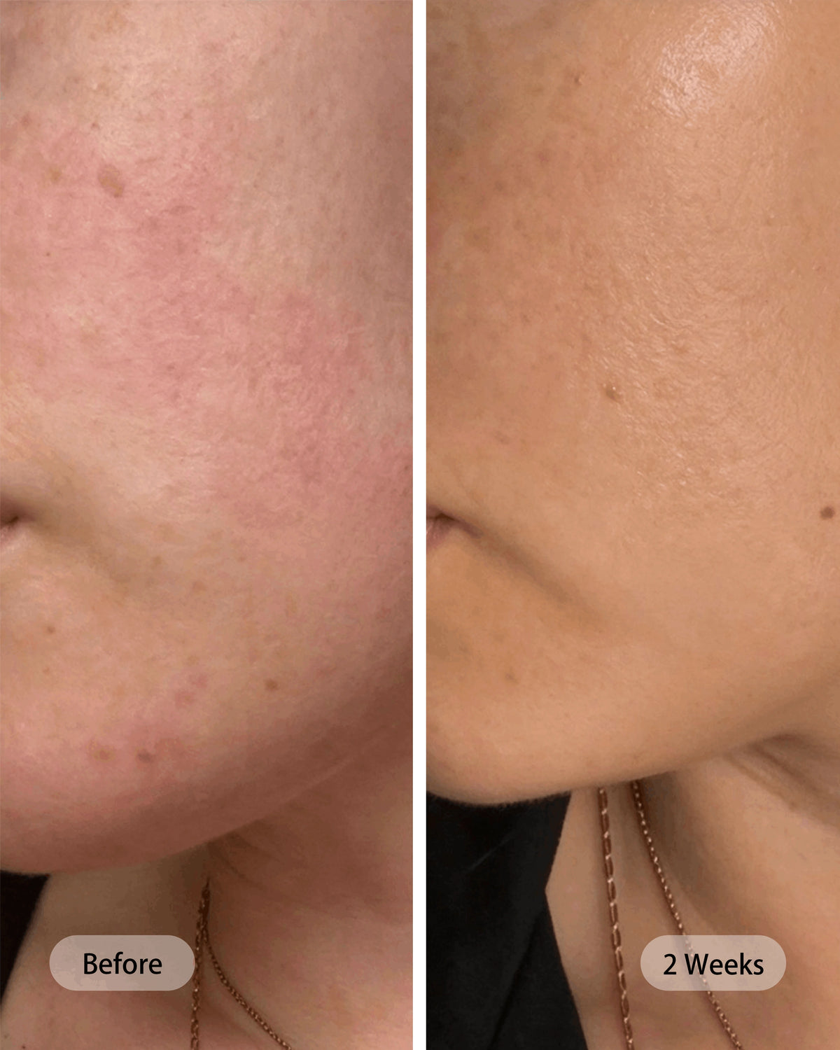 Umitec Before & After influencer 17