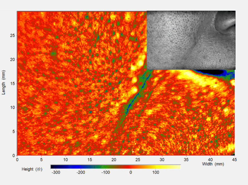 Scientific skin analysis showing a significant reduction in smile lines and nasolabial folds after using Umitec LED Mask Series 2, featuring a texture scan that demonstrates smoother skin around the mouth area.