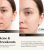 LED Light Therapy; Zonecraft; Red light therapy; Anti-aging; Anti-acne; Skincare; Skincare tools
