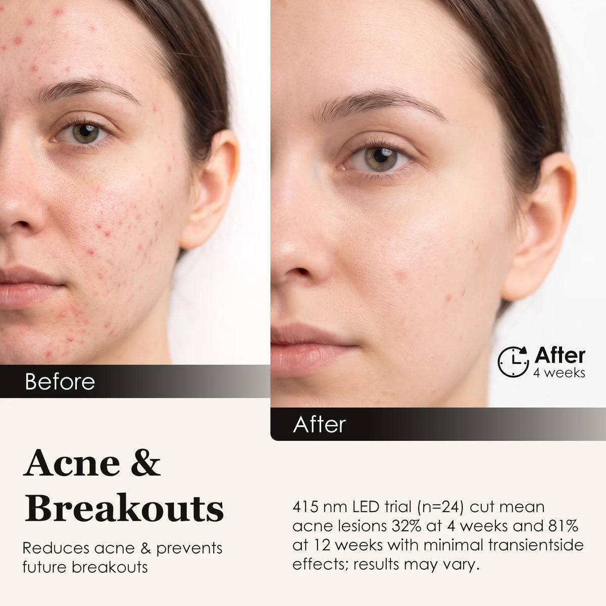 LED Light Therapy; Zonecraft; Red light therapy; Anti-aging; Anti-acne; Skincare; Skincare tools