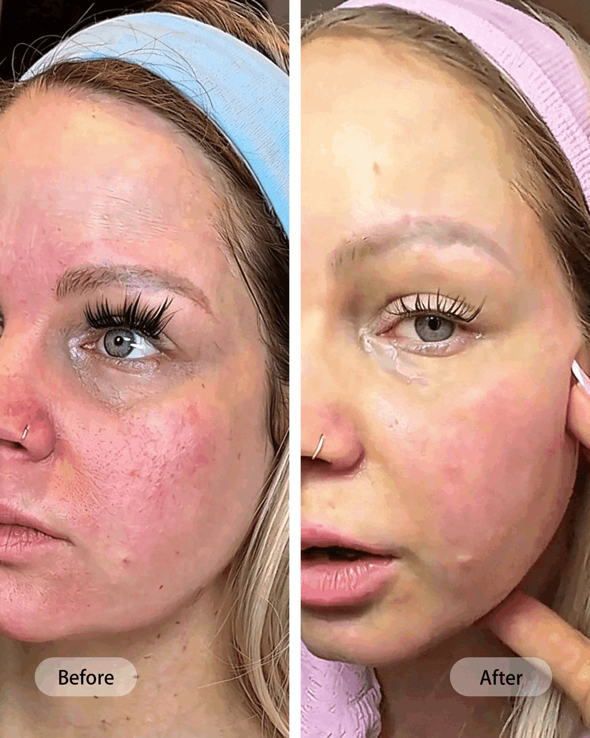 Umitec Before & After influencer 16