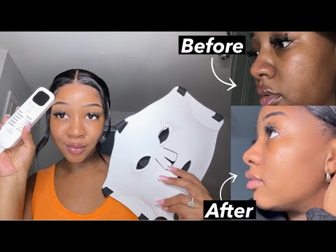 Real user before and after results using Umitec LED Therapy Mask, showing significant improvement in skin texture, radiance, and overall clarity on the face and profile.